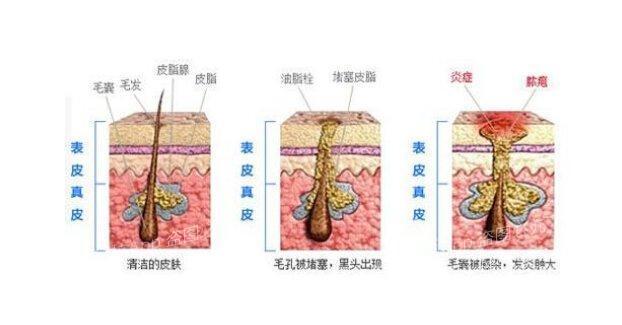 长痘原因你知吗?快看适合哪种医美祛痘
